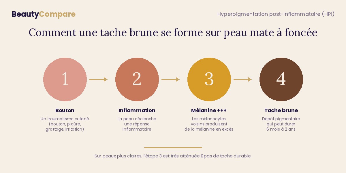 Hyperpigmentation post-inflammatoire — schéma des 4 étapes : bouton, inflammation, production de mélanine, tache brune durable
